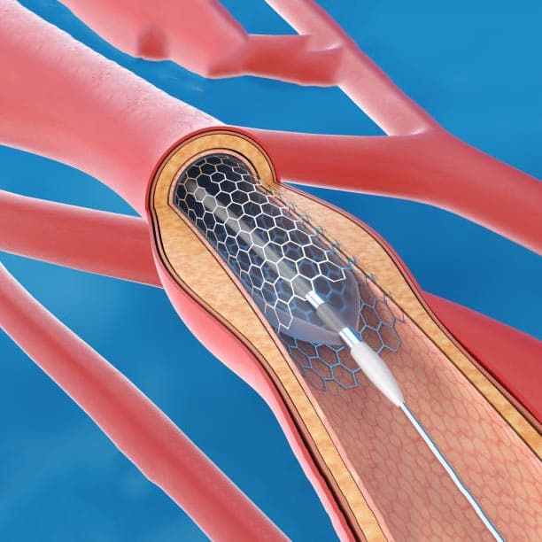 Coronary Stents